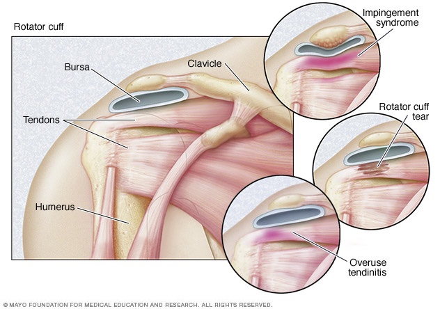 ROTATOR CUFF TEAR WHAT CAN BE DONE ABOUT IT The Orthobiologic Clinic