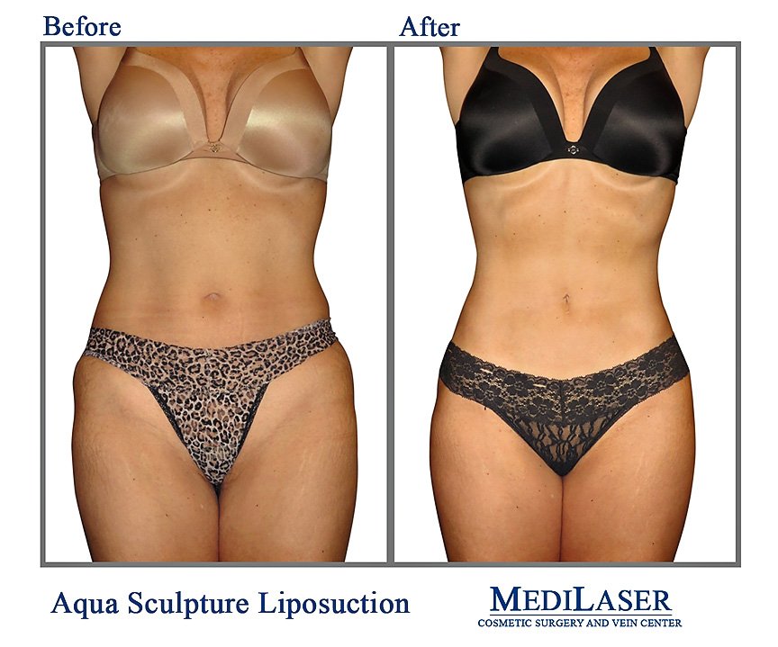 Aqua Sculpture Liposuction and Tummy Tuck Before and After - Medilaser  Surgery and Vein Center