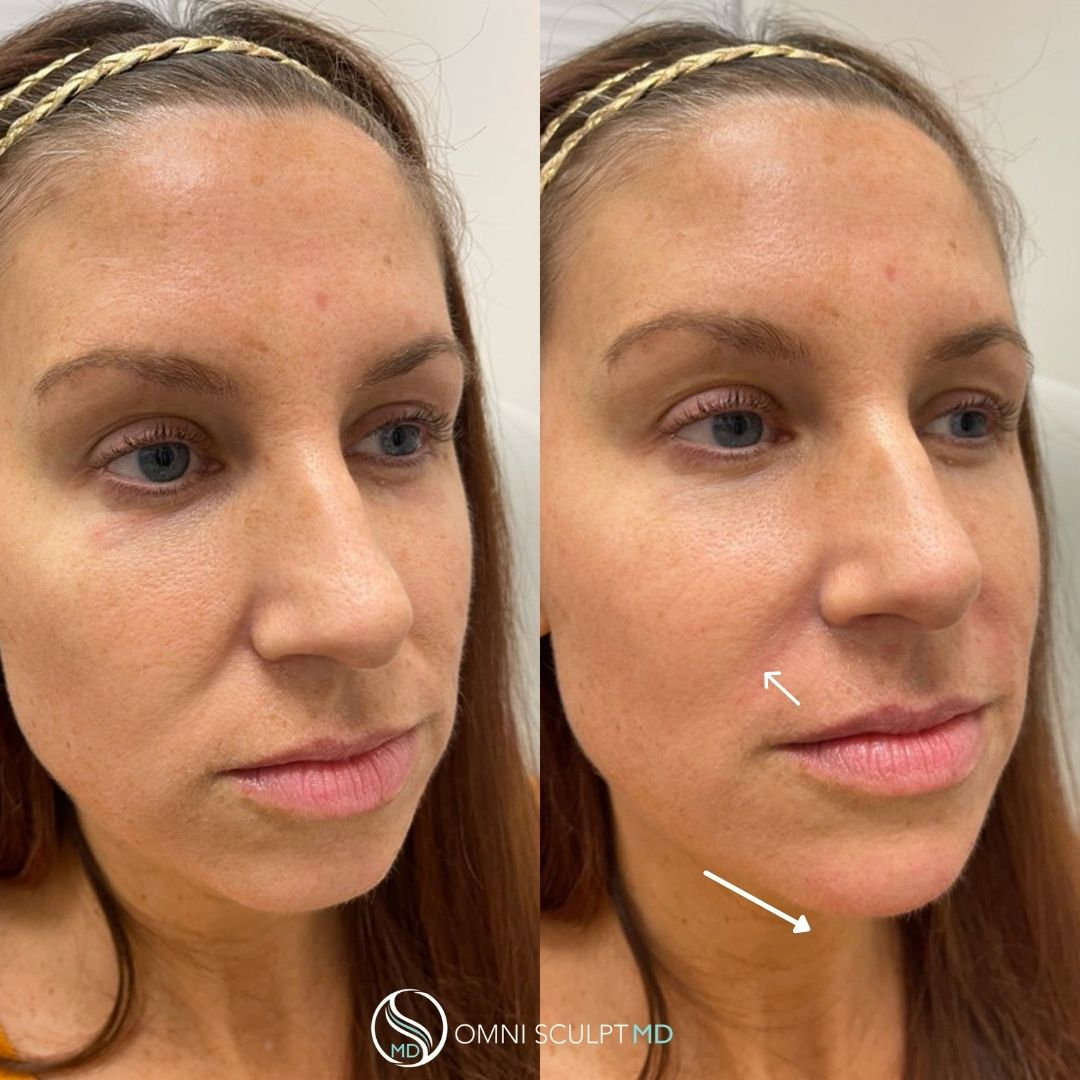 Chin and Jawline Filler in Dallas, TX OMNI SCULPT MD