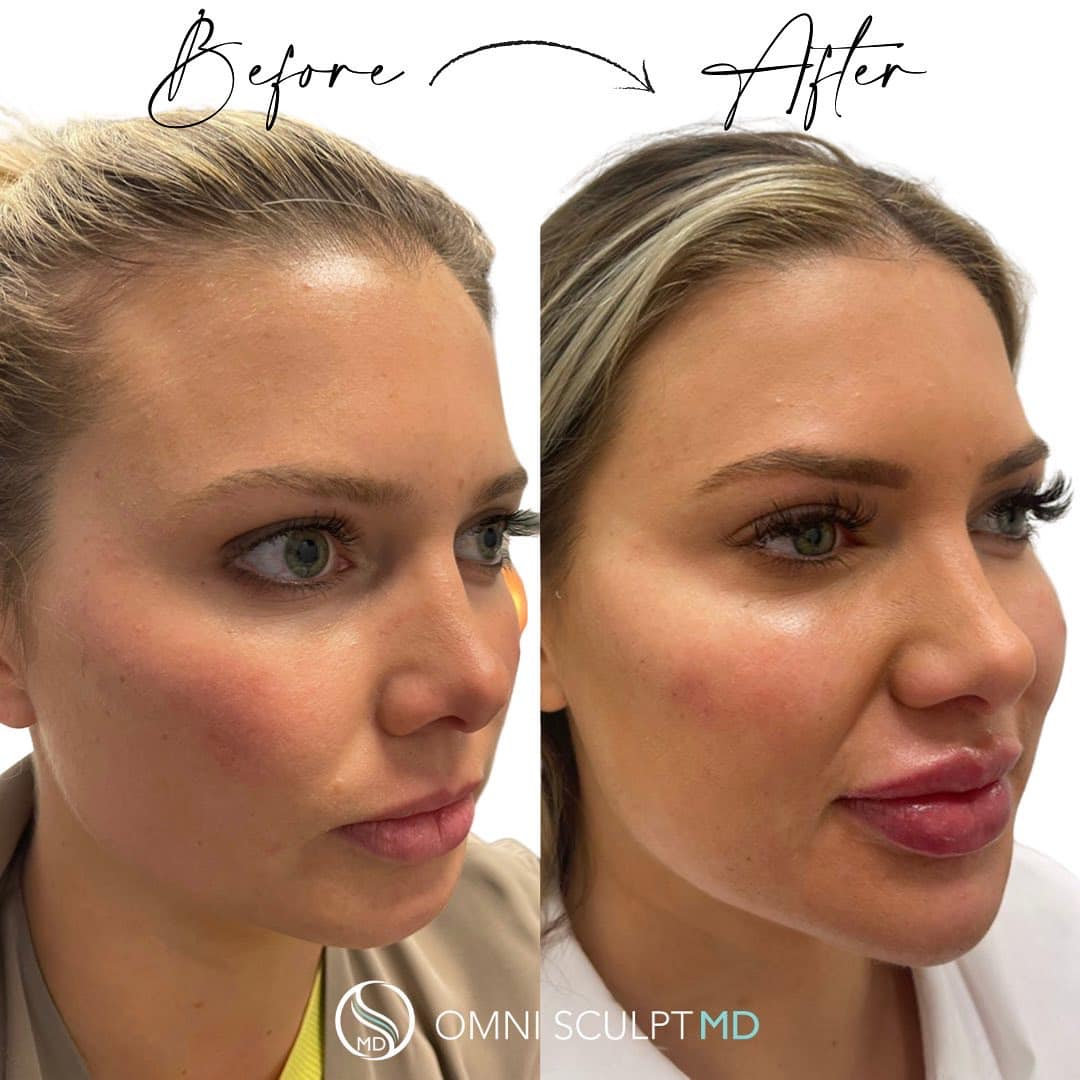 The Art Of Facial Balancing Omni Sculpt Md