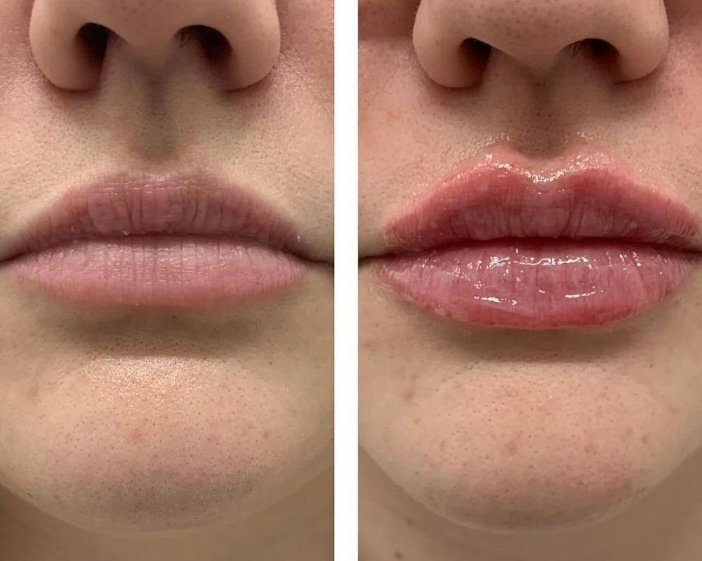 Lip Fillers Vs Lip Flip Omni Sculpt Md