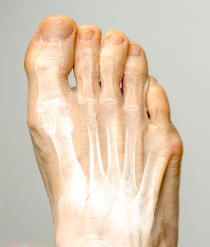(Tailor's Bunion) Foot & Ankle Centers of Frisco and Plano