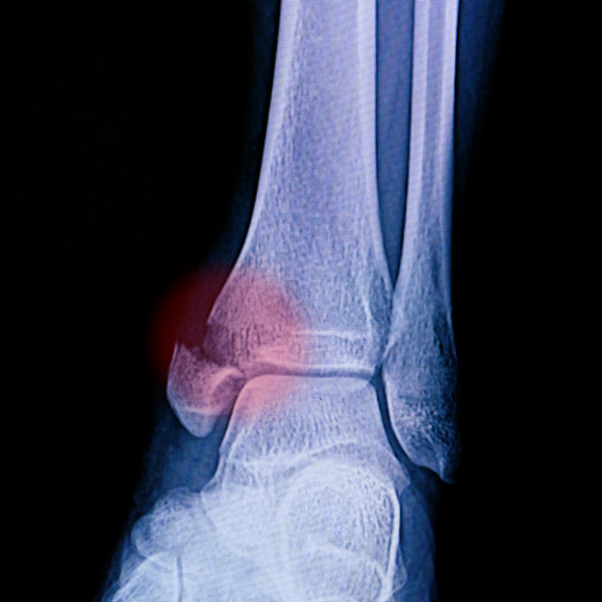 Stress Fractures of the Foot and Ankle 