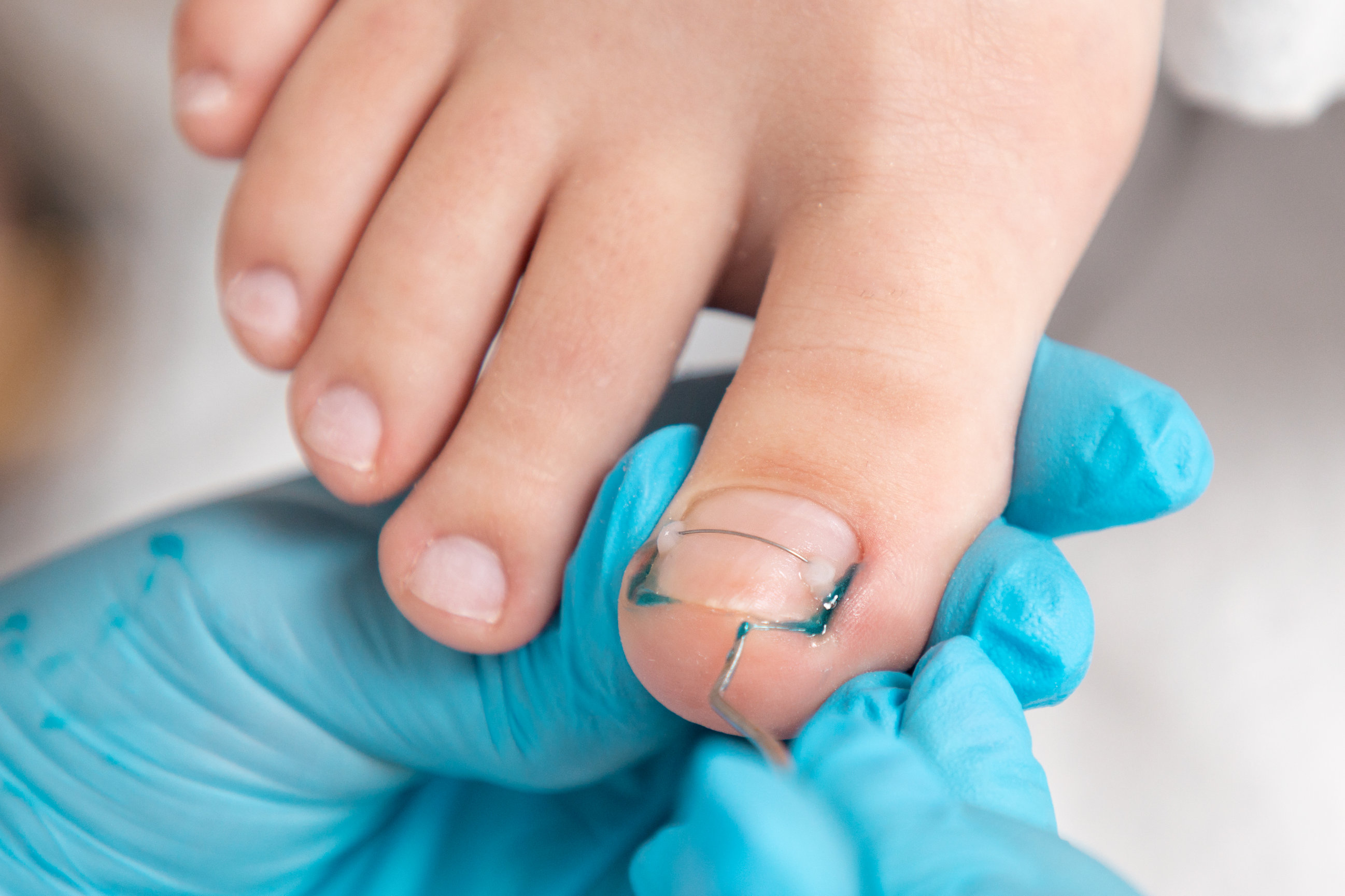 Treatment of Ingrown Toenail