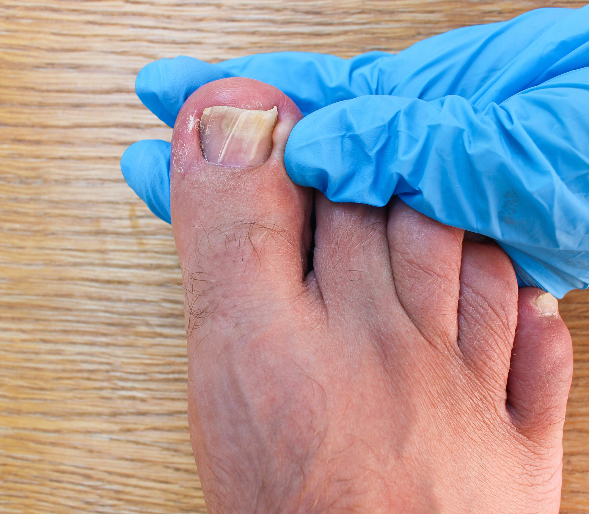 Painful Looking Ingrown Toenail