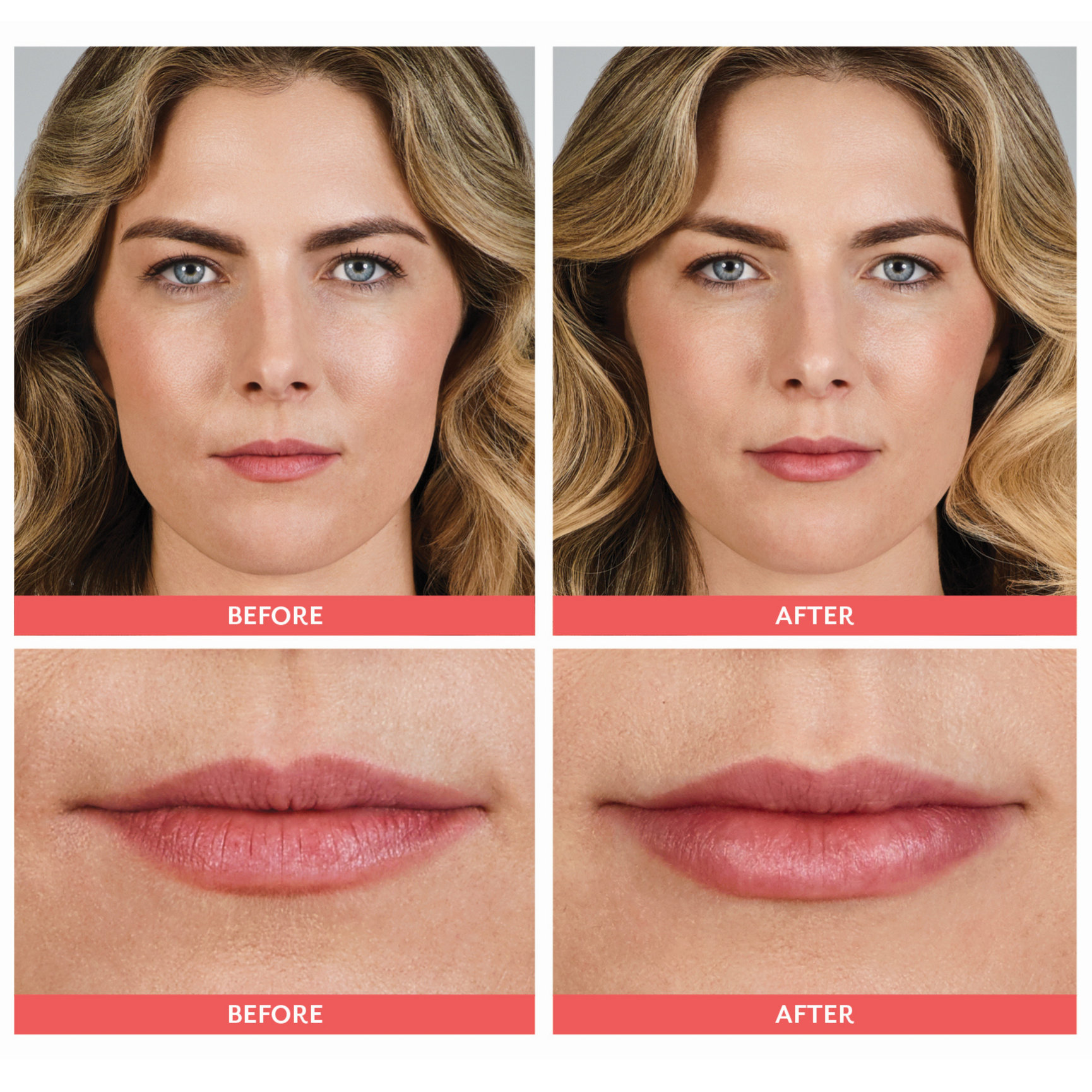 Lip Filler Before And After Feel Ideal Med Spa Southlake TX