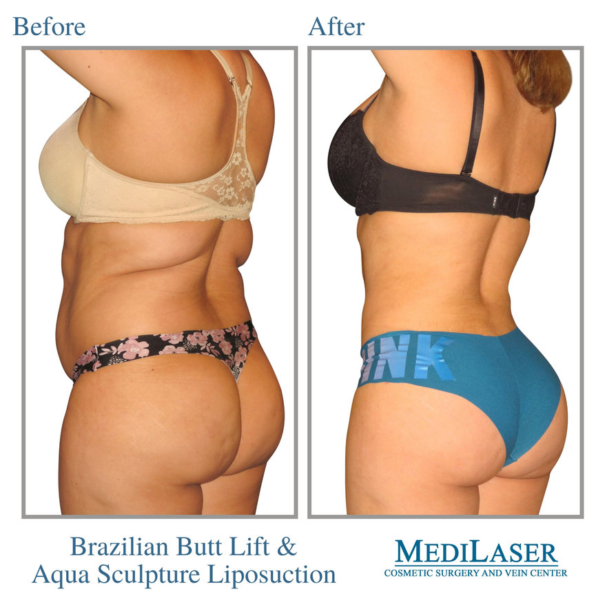 Brazilian Buttock Lift Before and After Pictures Case 294