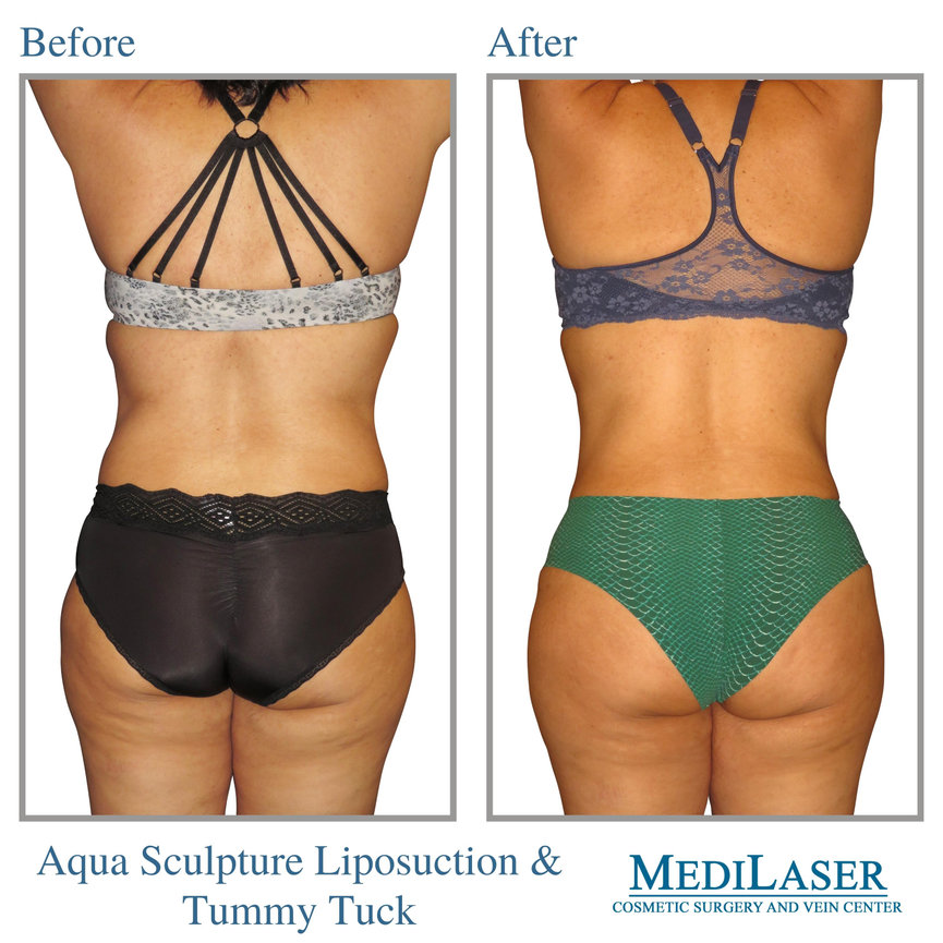 Tummy Tuck and Lipo Before and After Frisco Texas - Medilaser Surgery and Vein  Center
