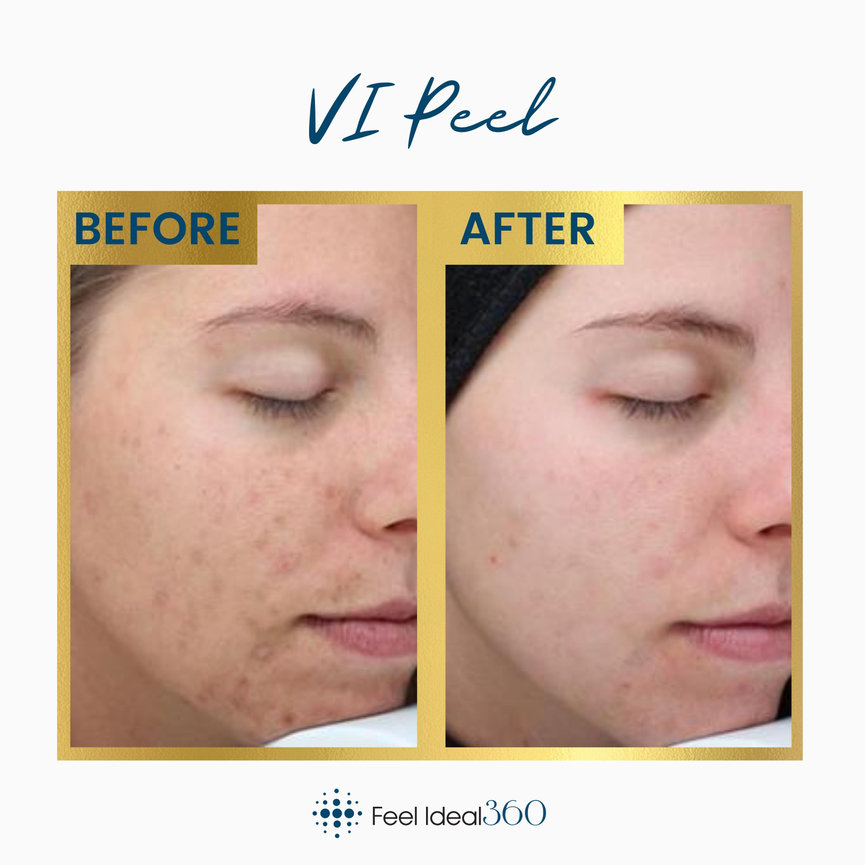 VI Peel Before and After - Feel Ideal 360 Med Spa - Southlake, TX