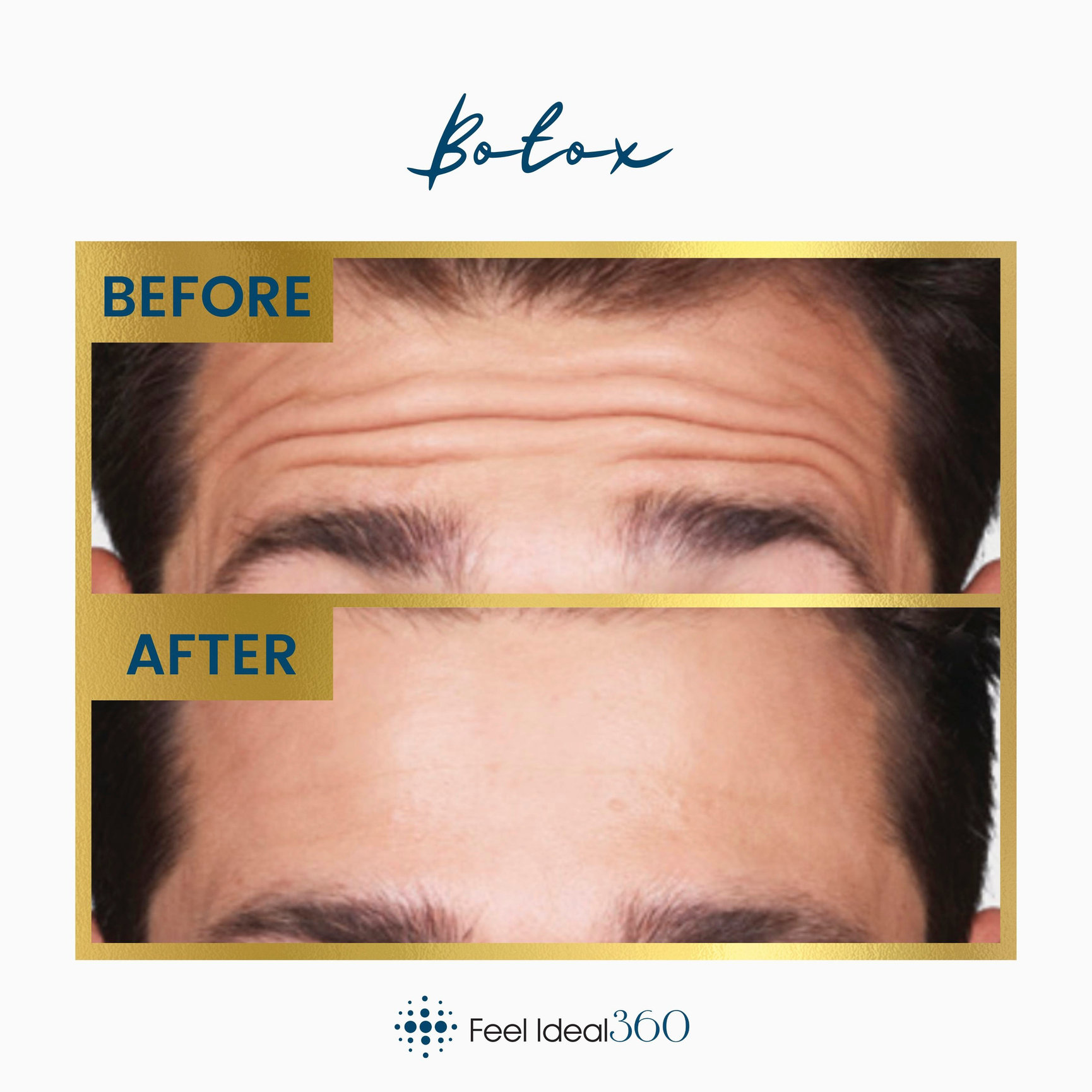 Botox Before And After Male Photos Feel Ideal 360 Med Spa