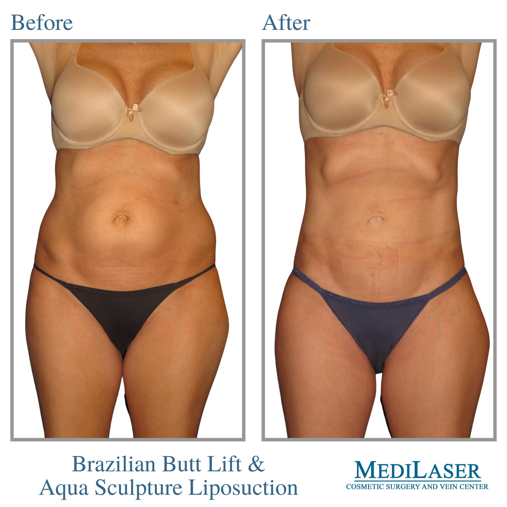 Brazilian Butt Lift Before and After - Medilaser Surgery and Vein Center