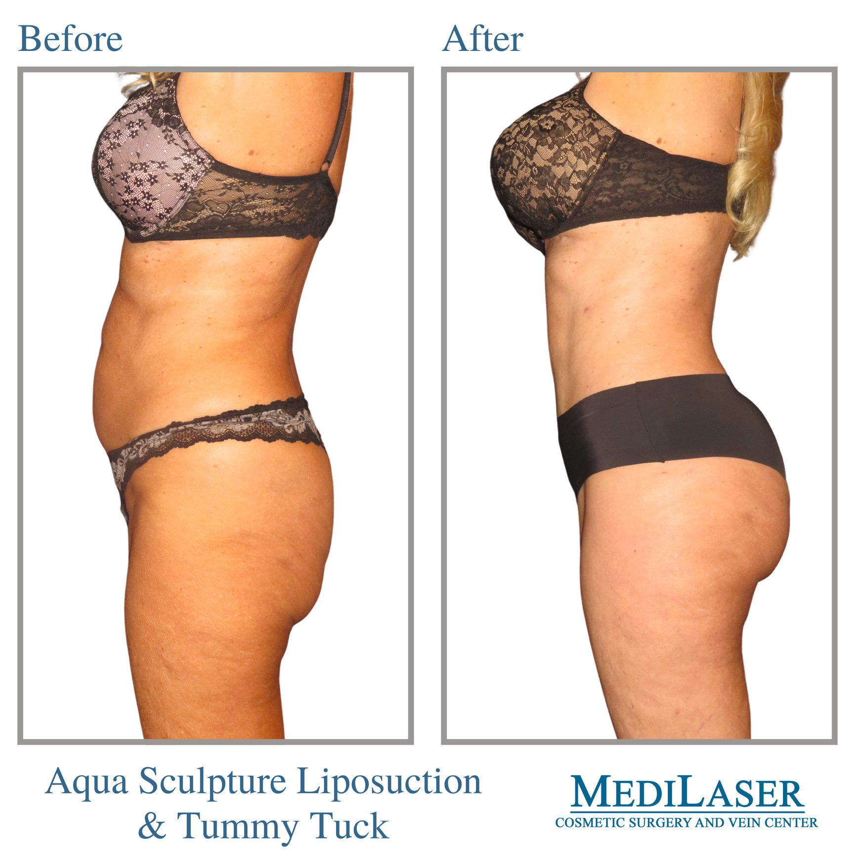 Tummy Tuck Liposuction Before and After - Medilaser Surgery and