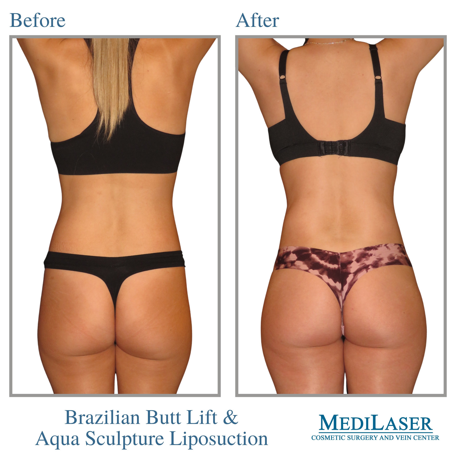 Brazilian Butt Lift Before and After Frisco Texas - Medilaser Surgery and  Vein Center