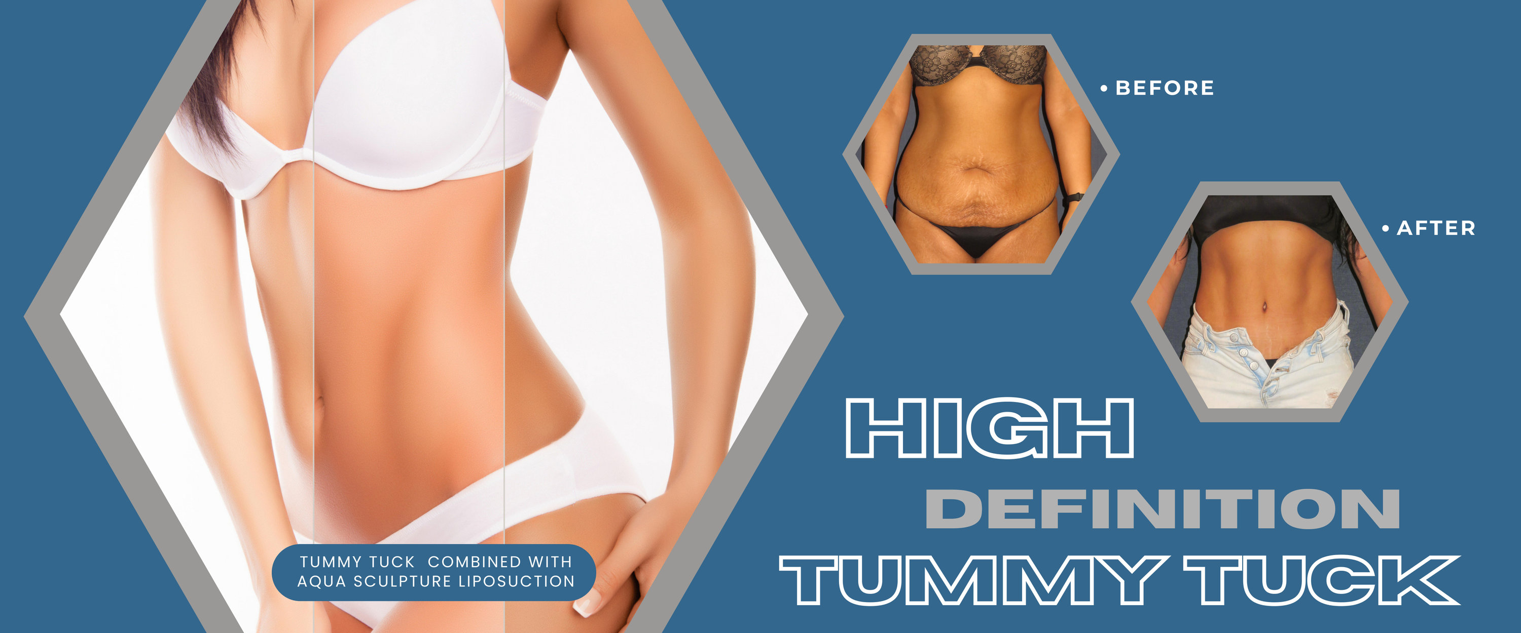 Tummy tuck (abdominoplasty)