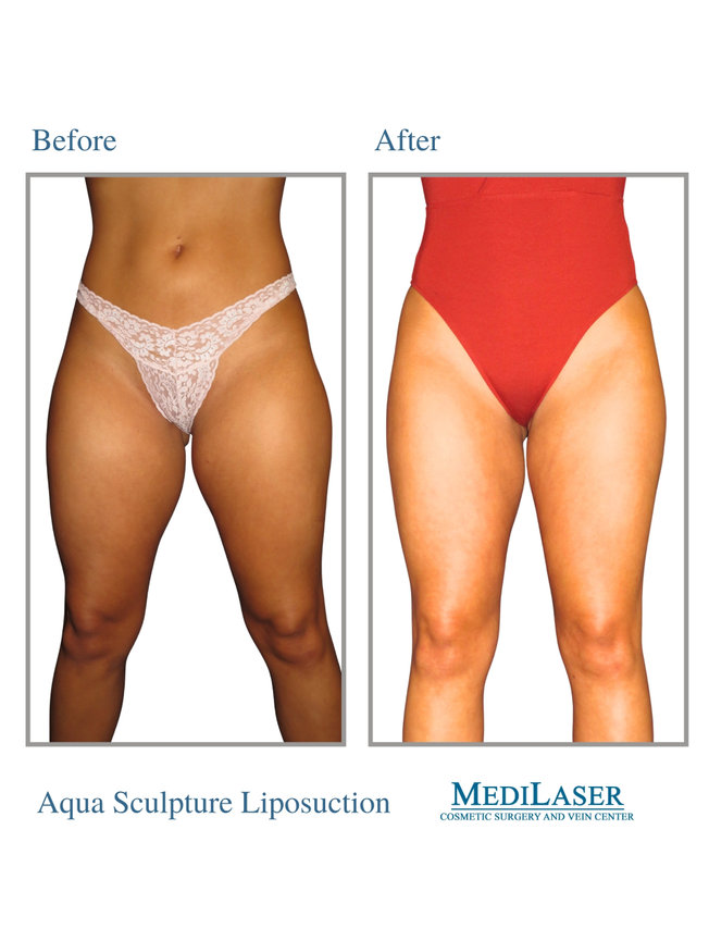 dermatology penile melanotic macules Penile Melanotic Macules: A Case Report